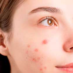 Leia mais sobre o artigo Ep138- Acne
